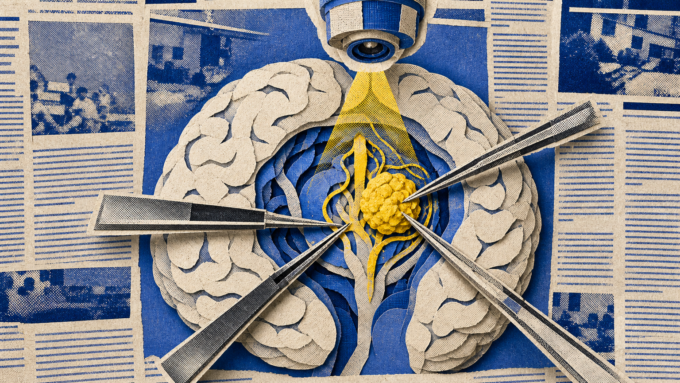 Top-down royal-blue newsprint collage showing AI-guided brain tumor surgery with a highlighted surgical area and delicate instruments.